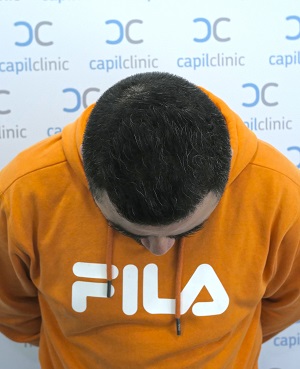 Resultado Injerto Capilclinic.jpg