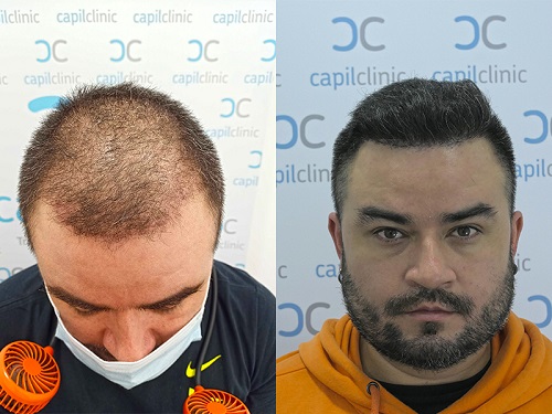 Antes y Despues Capilclinic.jpg